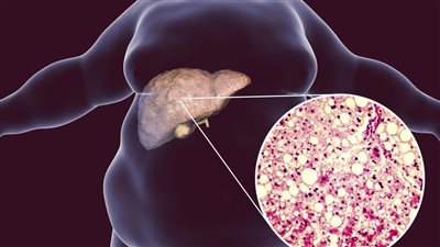 دراسة أمريكية: جراحات السمنة تحمي مرضى الكبد الدهني من المضاعفات
