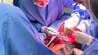 فى واقعة غريبة ..استخراج لوح خشبي من جسد شاب بمستشفى سوهاج الجامعى 