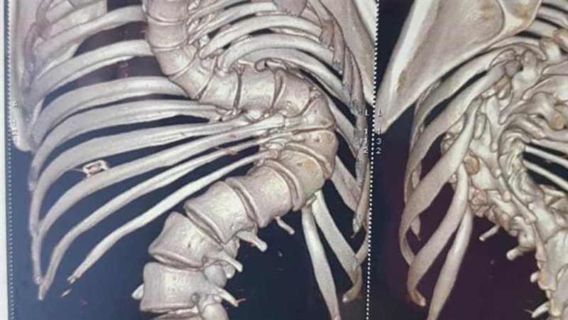 الفتاة قبل العملية