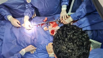 بنها الجامعي ينجح في تركيب دعامة مغطاة لمريضة تعاني من تمدد بالشريان