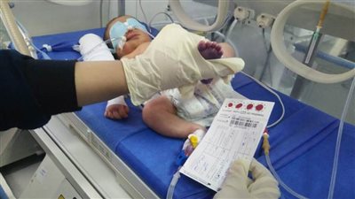 الصحة: فحص 45 ألف طفل من حديثي الولادة بمبادرة الكشف المبكر عن الأمراض الوراثية