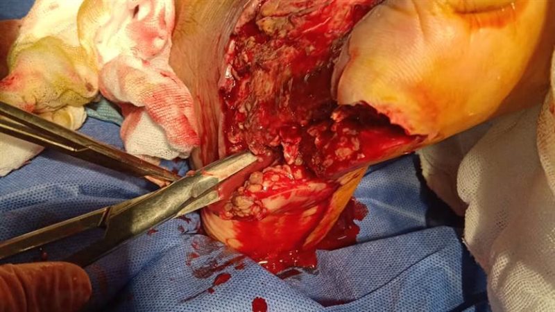 جراحة أوعية دموية