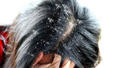 كيف تتخلص من قشرة الشعر في الشتاء؟ 