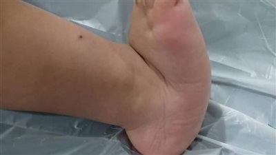 فريق طبي بحوش عيسى ينجح في تقويم الكاحل الخلقي العمودي لطفل يبلغ من العمر عامًا