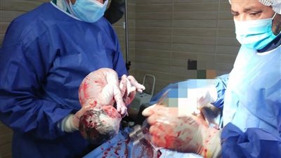 إجراء الولادة القيصرية الثامنة لسيدة تبلغ 38 عامًا بمستشفى أبو حماد المركزي