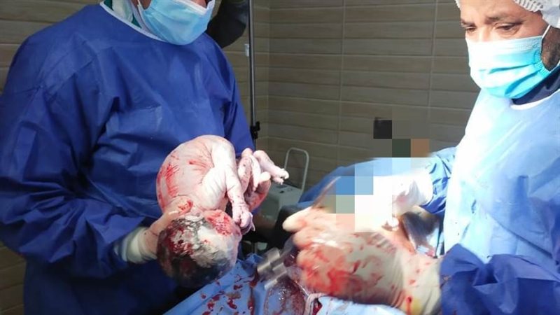 ولادة قيصرية