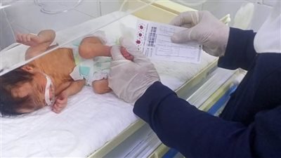 فحص 7 آلاف طفل للكشف المبكر عن الأمراض الوراثية بالشرقية