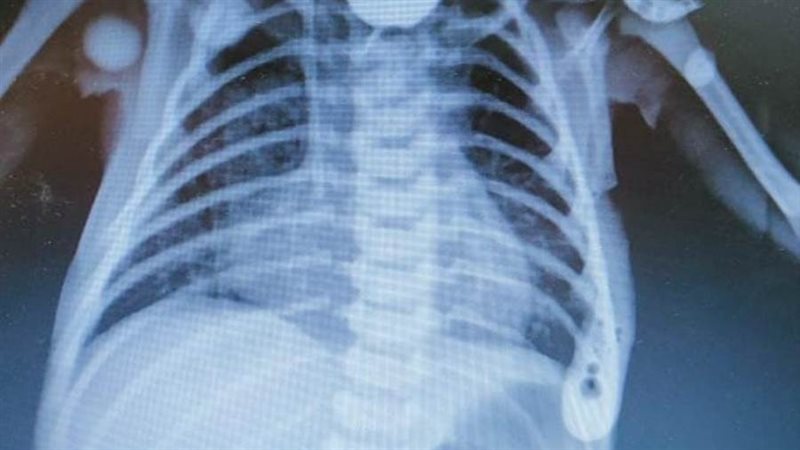 جراحة الطفل