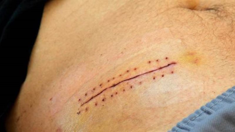 إزالة الزائدة الدودية