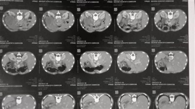 نجاح عملية جراحية لاستئصال جزء من الأمعاء الدقيقة لشاب بالبحيرة