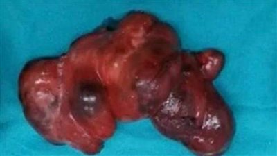 مستشفى ملوي التخصصي ينجح في إجراء أول عملية لاستئصال ورم كلي للغدة الدرقية