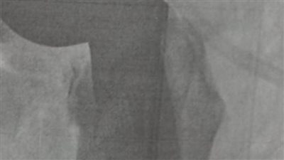 نجاح عملية تركيب نصف مفصل صناعي لمسن بمستشفى إدكو بالبحيرة