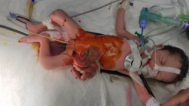 طفلة تعاني من عيب