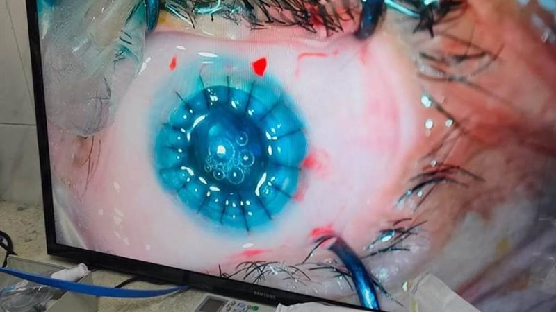 جراحة زرع قرنية