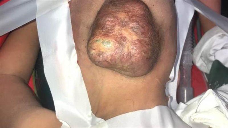 نجاح جراحة نادرة