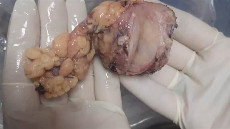 استئصال ورم من بنكرياس