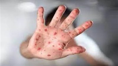 سويسرا تُسجِّلُ أول إصابة بجدري القردة