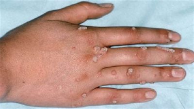 نيويورك تسجل أول إصابة بجدري القرود