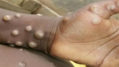 السطات الصحية الكندية تحقق في 3 حالات مشتبه بإصابتها بجدري القرود