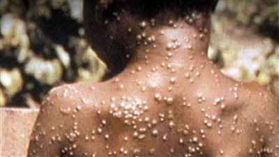 مركز مراقبة الأوبئة الأمريكي يرصد 9 إصابات بجدري القردة في 7 ولايات