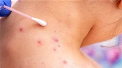 فنلندا تسجل أول حالة إصابة بجدرى القرود