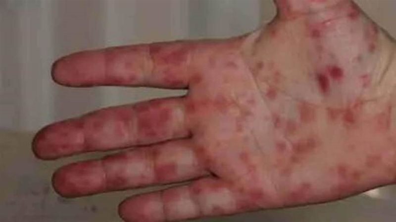 أعراض انفلونزا الطماطم