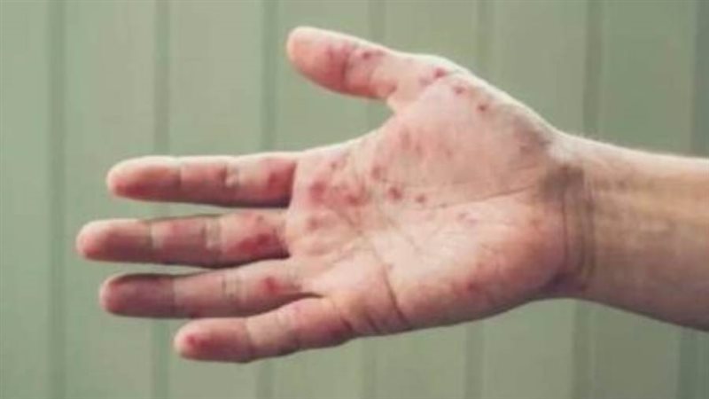 جدري القرود