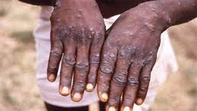 نيجيريا تسجل 21 إصابة بجدري القرود خلال 2022