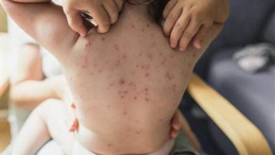 المملكة المتحدة تسجل 71 إصابة جديدة بفيروس جدري القردة