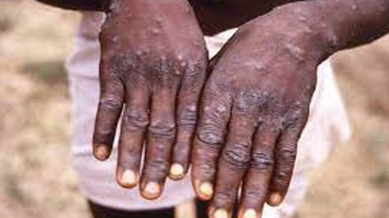 جدرى القرود - ارشيفية