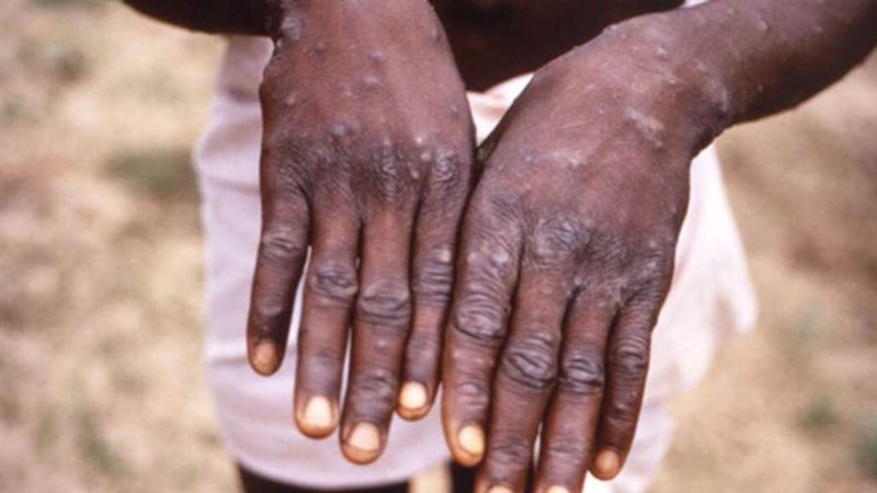 جدري القردة