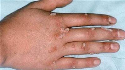 الولايات المتحدة ترصدُ 19 إصابةً بجدري القردة في عشر ولايات