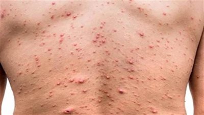 خبراء أمريكيون: حالات الإصابة بجدري القردة أصبحت صعبة للتشخيص