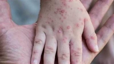 بريطانيا: ارتفاع عدد الإصابات المؤكدة بجدري القردة إلى 470 إصابة