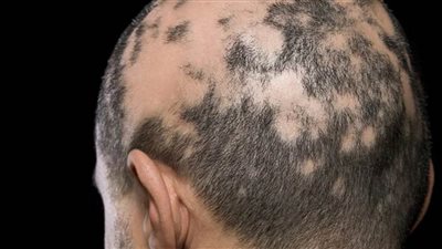 إدارة الغذاء والدواء الأمريكية توافق على علاج لمرض الثعلبة للجسم كاملا