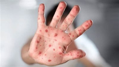 الولايات المتحدة ترصد 72 إصابة بجدري القردة