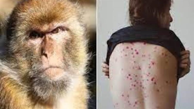 جدري القرود