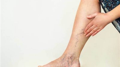 دراسة تشير إلى أهمية الخيار الجراحي في الدوالي المرتبطة بعامل وراثي