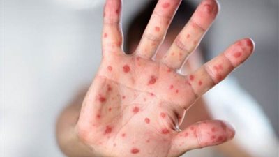 ارتفاع حالات الإصابة بمرض جدري القرود في البرتغال إلى 297 حالة