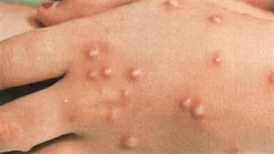 كندا تجري مباحثات للحصول على المزيد من لقاح جدري القرود