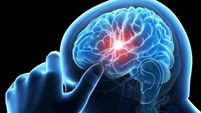 مؤشر حيوي في أدمغة بعض النساء يمكن أن يزيد من خطر الإصابة بالسكتة الدماغية