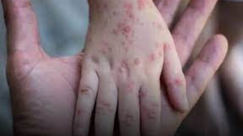 جدري القرود