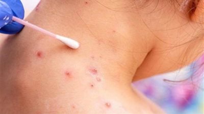 الصحة اللبنانية تعلن اكتشاف 4 إصابات بجدري القردة ورصد 20 حالة اشتباه