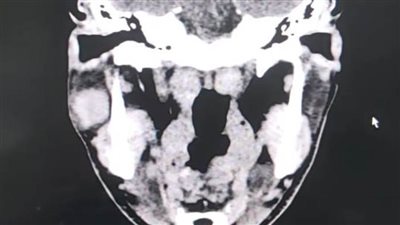 نجاح مستشفى إدكو المركزي في إجراء عملية دقيقة لإزالة ورم من الغدة النكافية