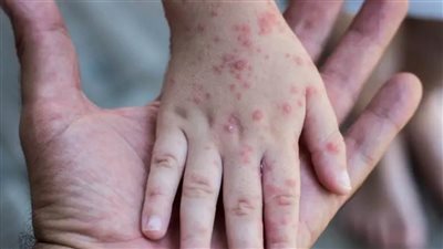 بعد إنذار منظمة الصحة العالمية.. 30 معلومة عن جدري القرود وتاريخه