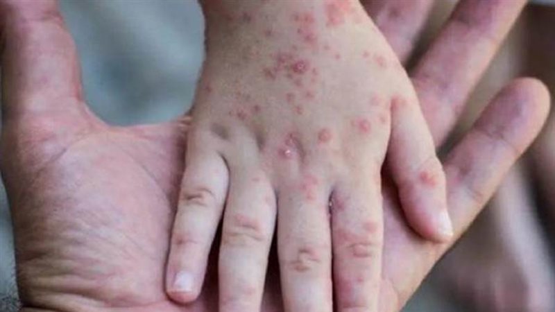 جدري القردة - ارشيفية