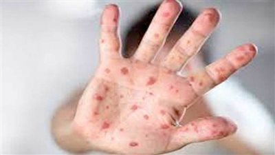 وزارة الصحة تحسم الجدل وتحدد أعراض الإصابة بجدري القرود 