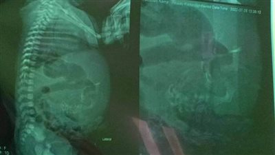 ولادة طفلة تحمل جنينًا في بطنها بالدقهلية.. وطبيب يكشف التفاصيل 