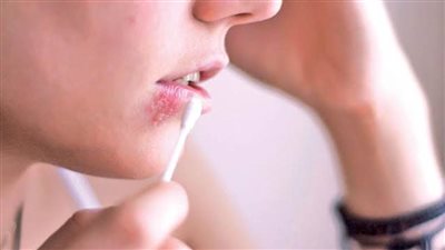 دراسة بريطانية: فيروس الهربس قد يسبب مرض الزهايمر