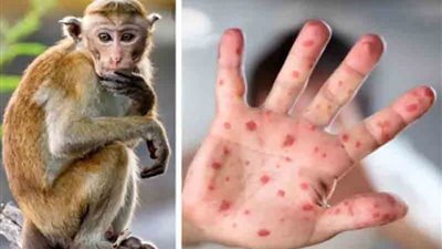 وفاة ثاني حالة إصابة بجدري القردة في إسبانيا